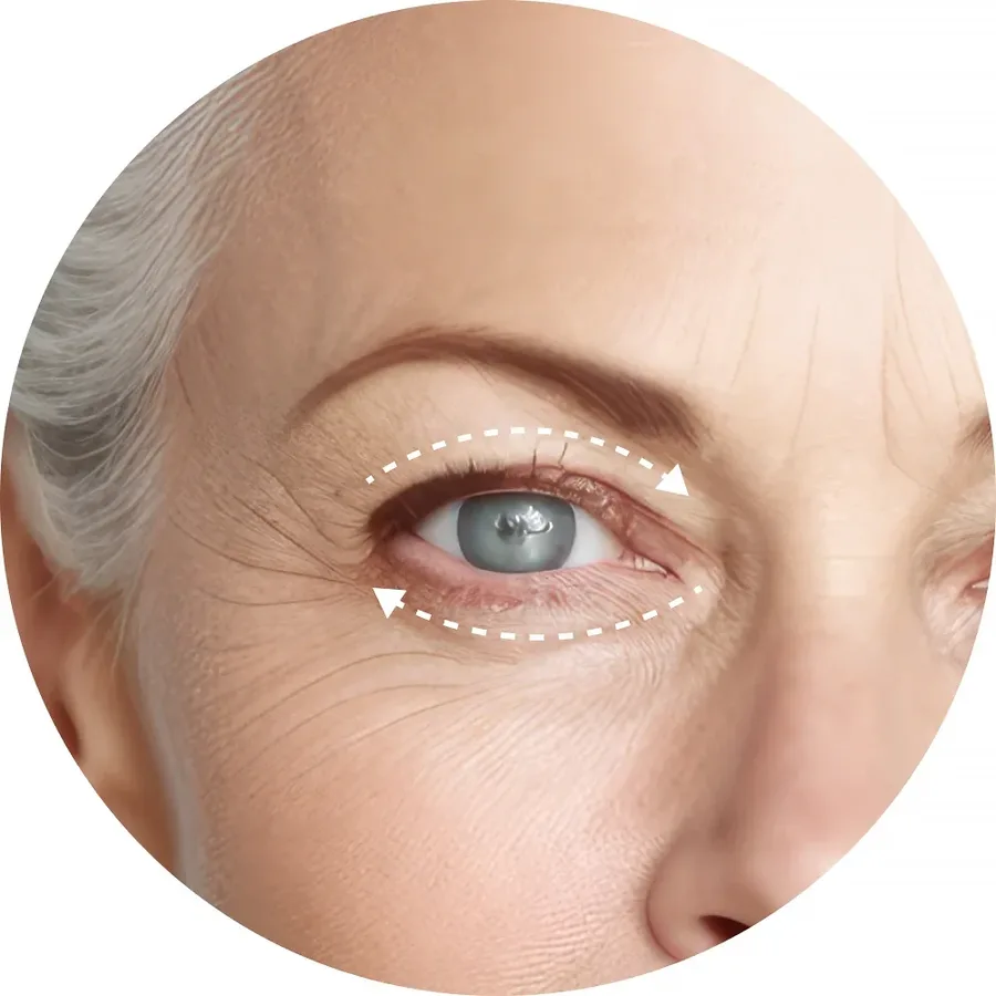 Augenpartie einer Frau, Pfeile zeigen die Behandlungsrichtung um das Auge